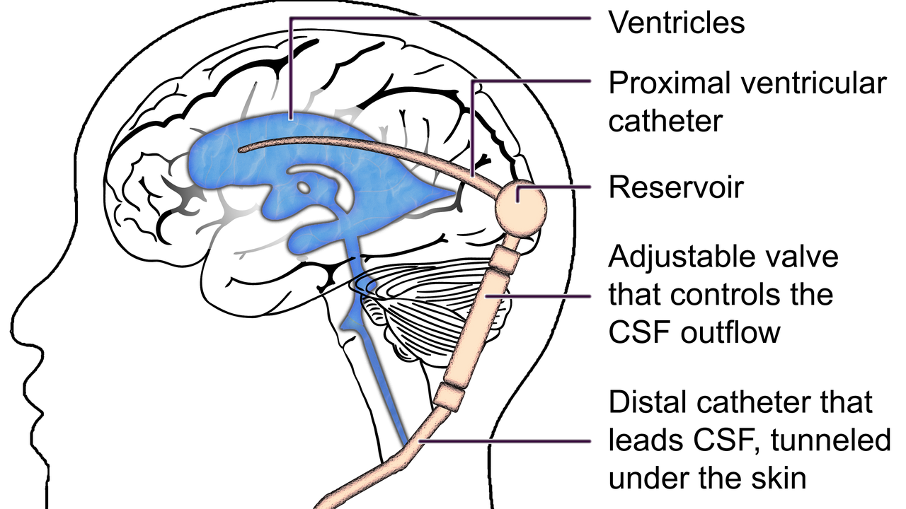 schematisk skiss av shuntmekanism som reglerar vätsketrycket i hjärnan