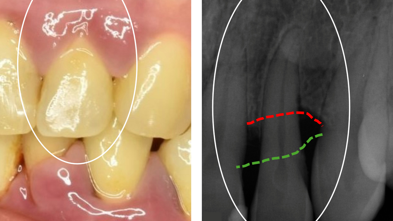 Bild på tänder i käke till vänster, till höger röntgenbild