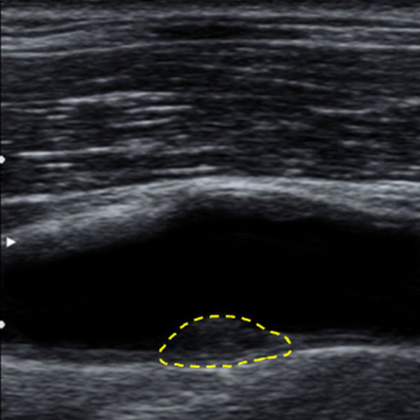 Ultraljudsbild av halsartär där plack är inringat.