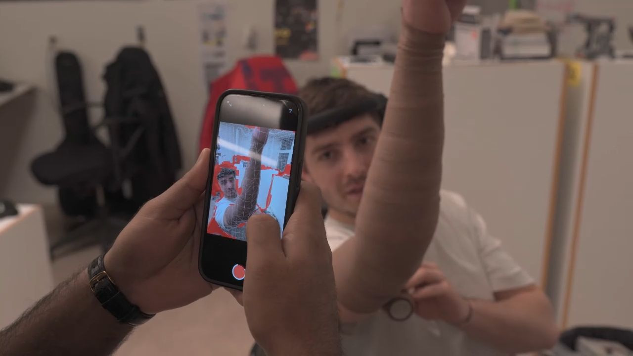 Film: NextGen low-cost prosthetics – A degree project