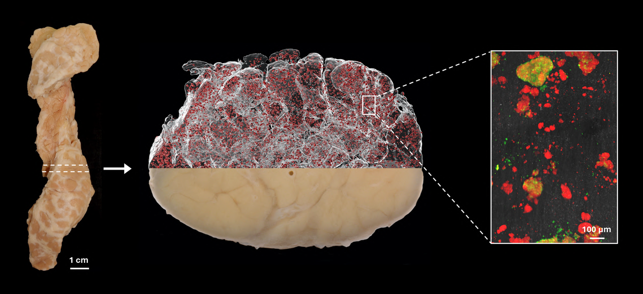 Illustrationen visar hur en hel bukspottkörtel (t.v.) från en avliden donator kan färgas in med antikroppar för olika celltyper och avbildas med optisk projektionstomografi (i mitten, Insulinfärgade öar i rött). Den kan sedan studeras i högre upplösning med ljusfältsmikroskopi (t.h.). Det röda är insulin och det gröna glukagon.