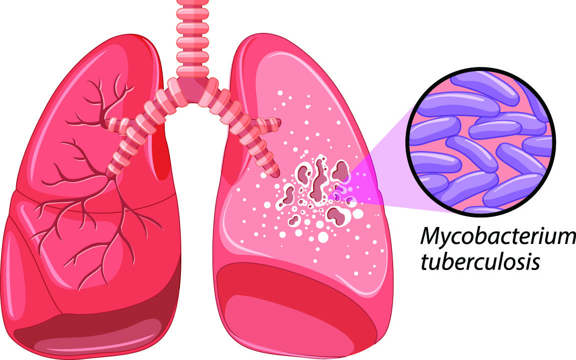 Illustration över lungor angripna med tuberkulos.