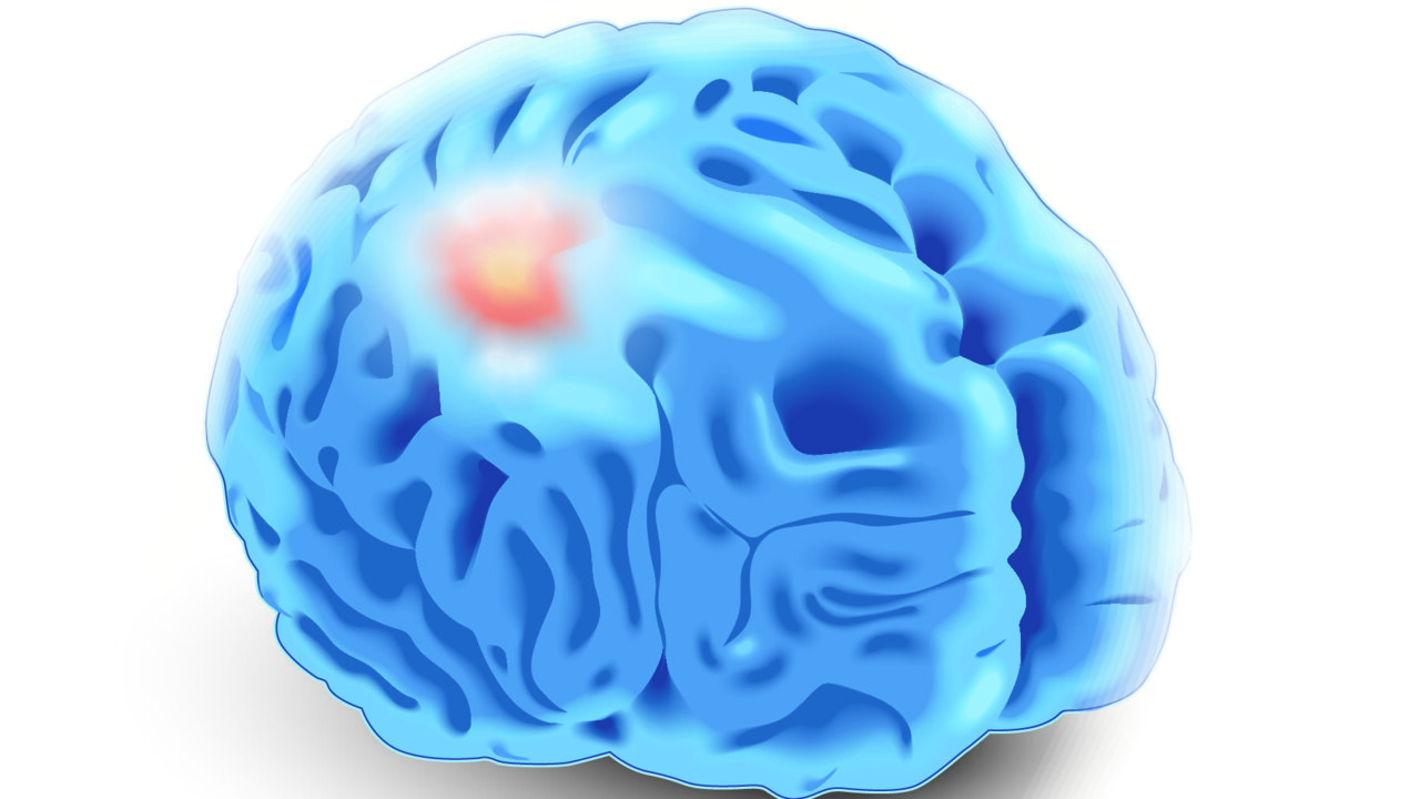 Illustration av hjärntumör.