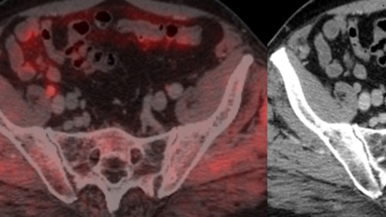 Skiktröntgen isotopspårning prostatametastase