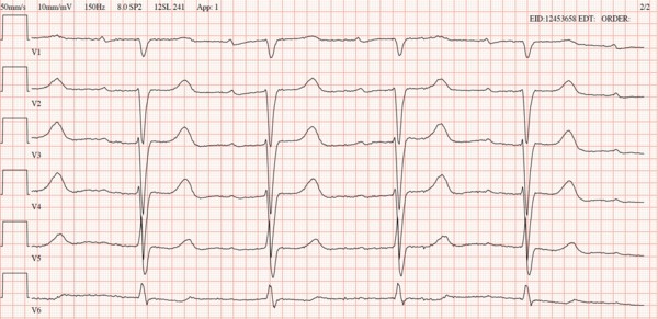 EKG hos patient med wtATTR
