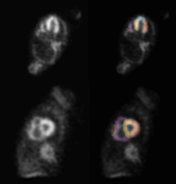 99mTc-DPD scintigrafi