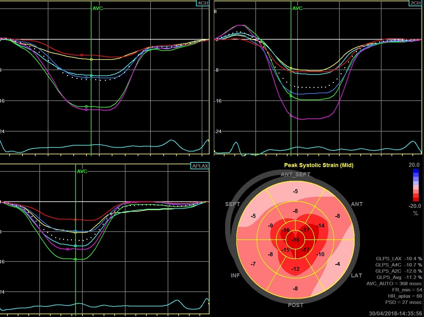Ekokardiografi med strain teknik